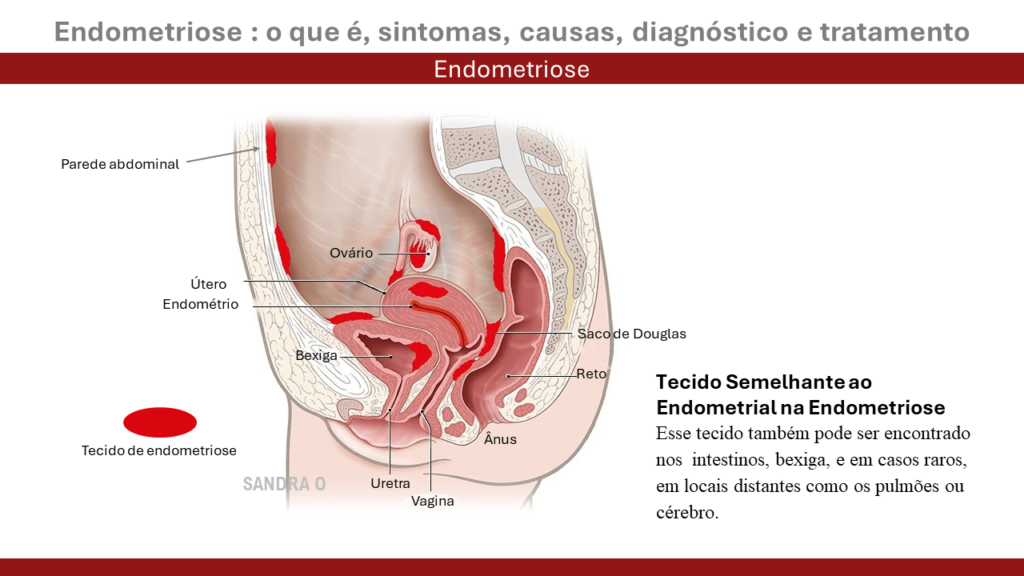 Endometriose espalhada na cavidade pélvica e abdômem