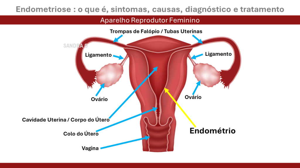 Endometriose O que é