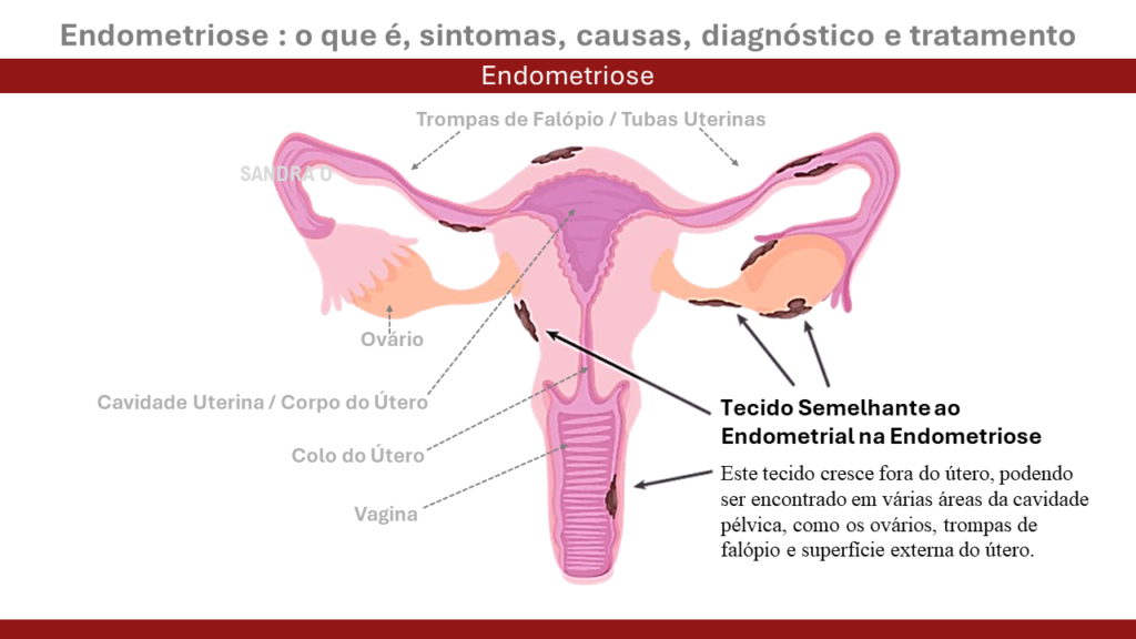 Útero e ovário com endometriose