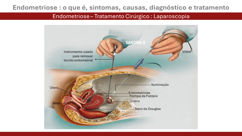 Endometriose tratamento com laparoscopia