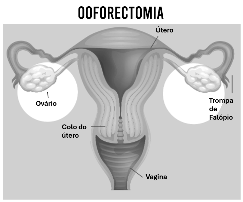 Menopausa precoce Ooforectomia imagem