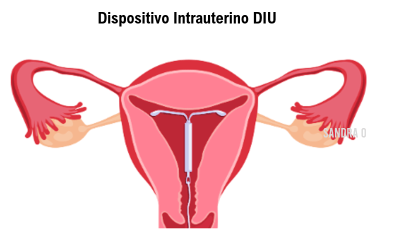 Menstruação Retrógrada DIU Dispositivo Intrauterino Imagem