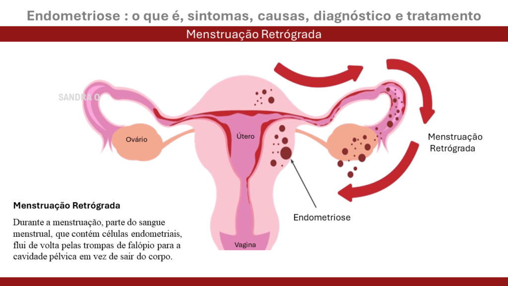 Menstruação retrógrada pode causar endometriose