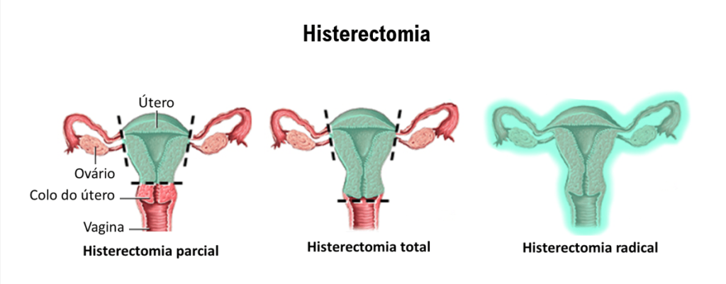 Menstruação Retógrada Histerectomia Partial Total Radical Imagenm