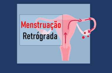 Menstruação Retrógrada – O que é, causas, sintomas, tratamento