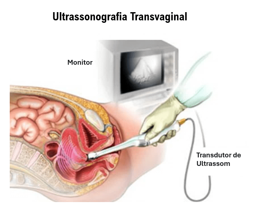 Ultrassonografia Transvaginal Imagem