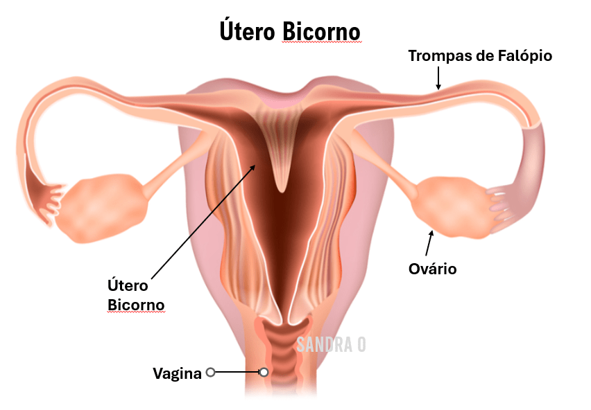 Menstruação Retrógrada Útero Bicorno Imagem