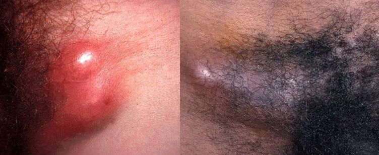 Linfogranuloma venéreo imagem