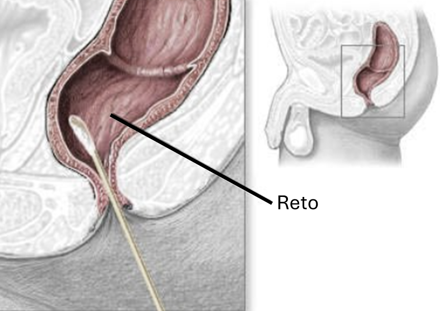 linfogranuloma venéreo swabs anal